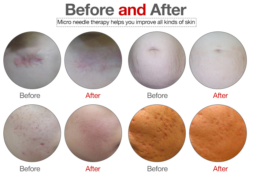 buy dermapen body skin care