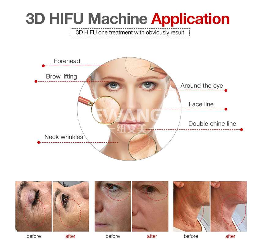 HIFU machine facial lifting anti wrinkle