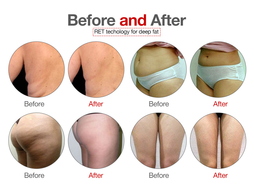 ret fat Before and After