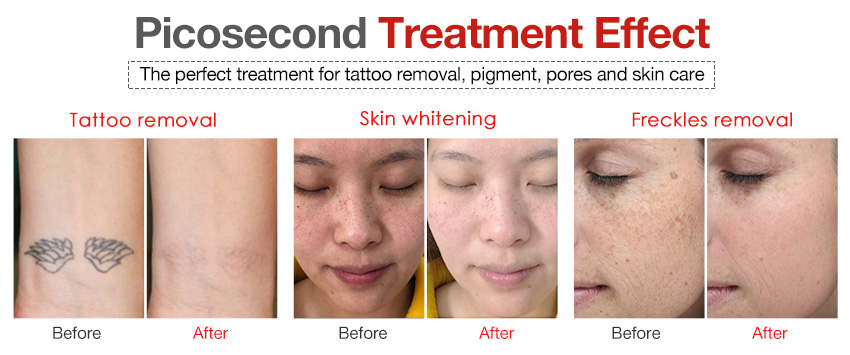 Fresh tattoo removal picosecond laser machine for freckle eyebrow 