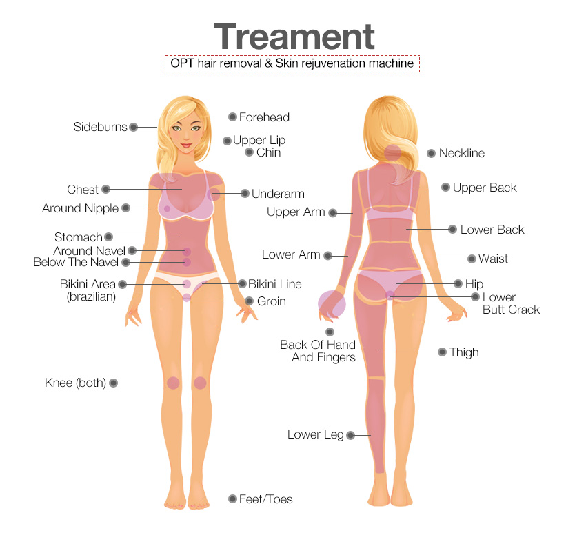 OPT hair removal treatment