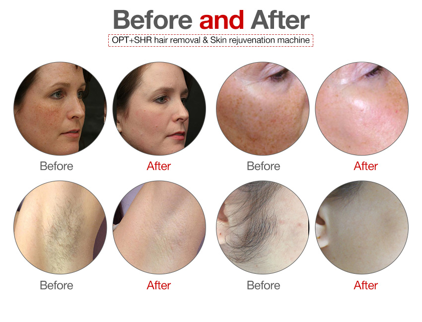 OPT SHR hair removal contrast before and after