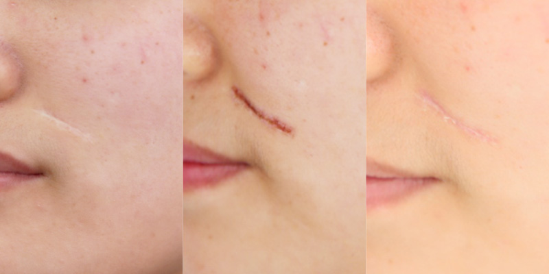 fractional-co2-laser-acne-removal-before-and-after