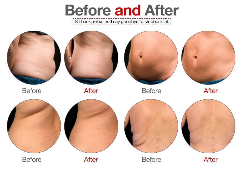 Top cryolipolysis machine quickly fat reduction