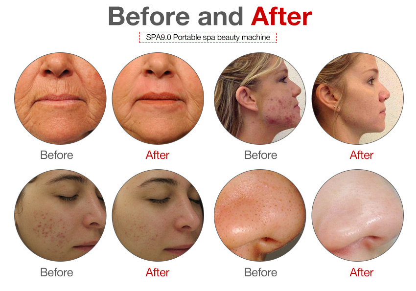 professional skin care microdermabrasion machine for sale